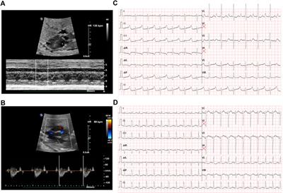 Case Report: A novel KNCH2 variant-induced fetal heart block and the advantages of fetal genomic sequencing in prenatal long-term dexamethasone exposure